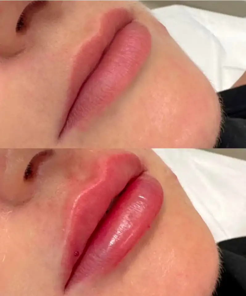 Увеличение губ, фотография 4