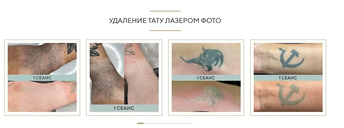 Безболезненное удаление татуировок лазером от 1000 рублей, фотография 2