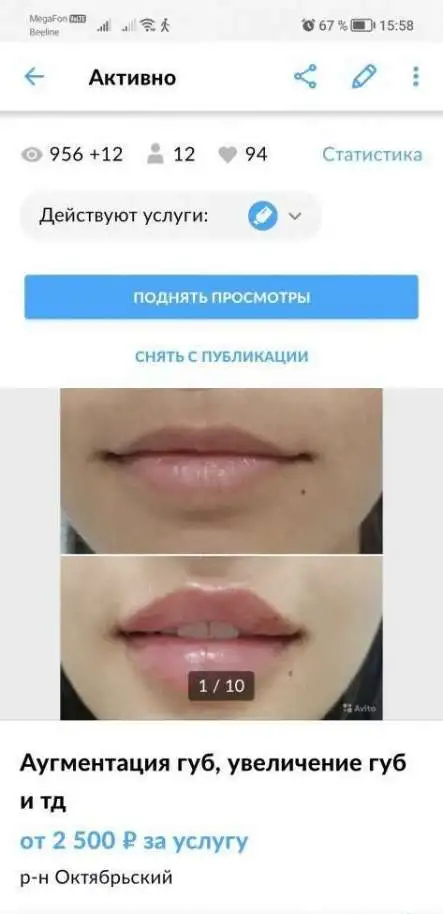 Увеличение губ, моно нити, коги, фотография 3