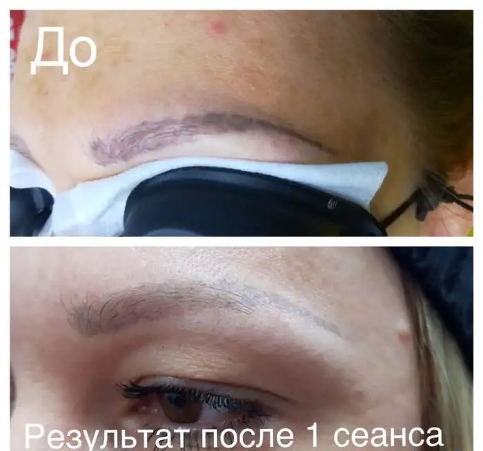 Лазерное удаление татуировок и татуажа в СВАО, фотография 8