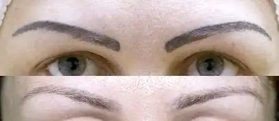 Удаление татуировок и перманентного макияжа, фотография 1