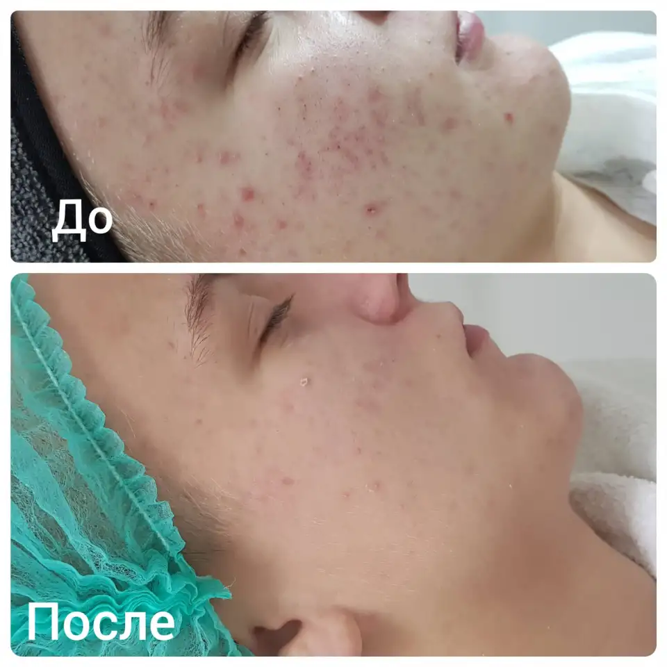 Чистка кожи. Лечение проблемной кожи, фотография 1