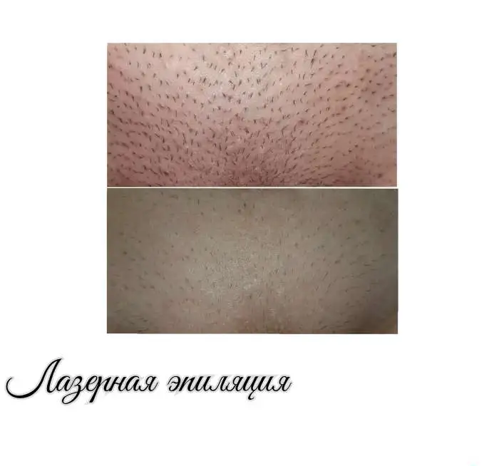 Лазерная эпиляция, РФ-ЛИФТИНГ, КАВИТАЦИЯ,LPG, фотография 2