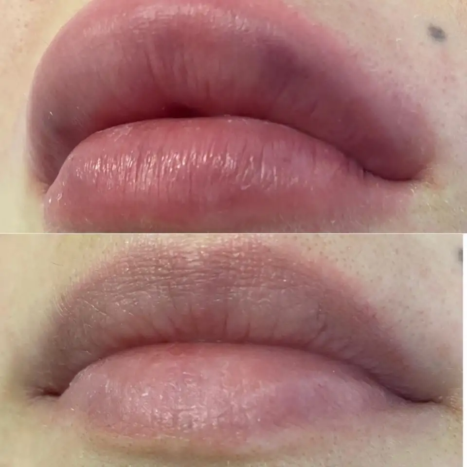 Увеличение губ, Juviderm Smile,0,55 ml, фотография 3