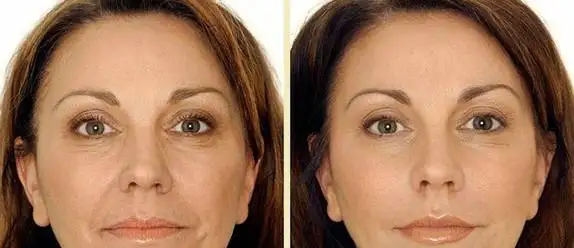Нити Aptos. Лифтинг. ПОДТЯЖКА лица без операций., фотография 9
