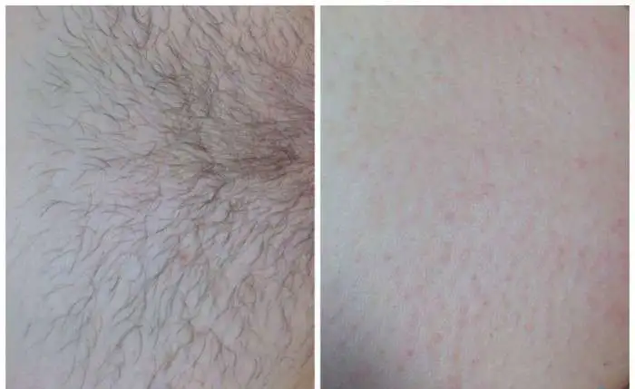 Шгаринг депилиляция, фотография 2