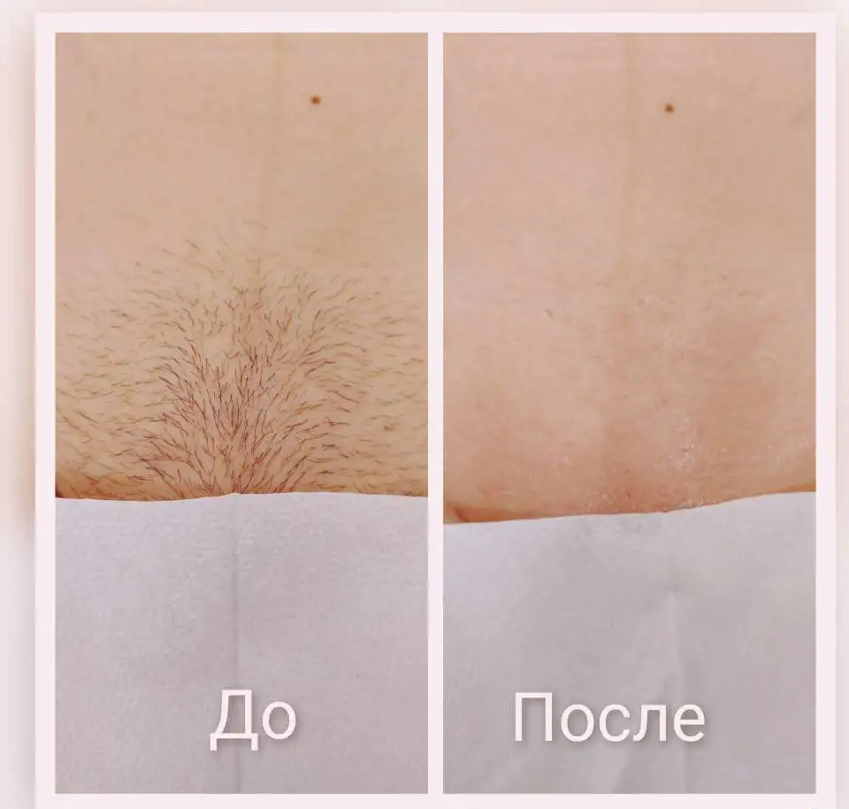 Шугаринг Ульяновск, фотография 6