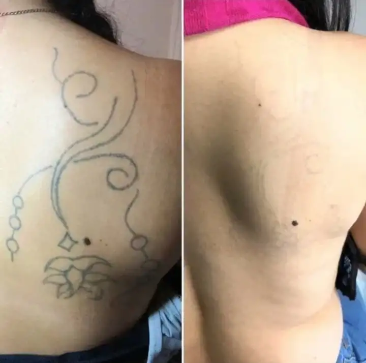 Удаление тату и татуажа, фотография 2