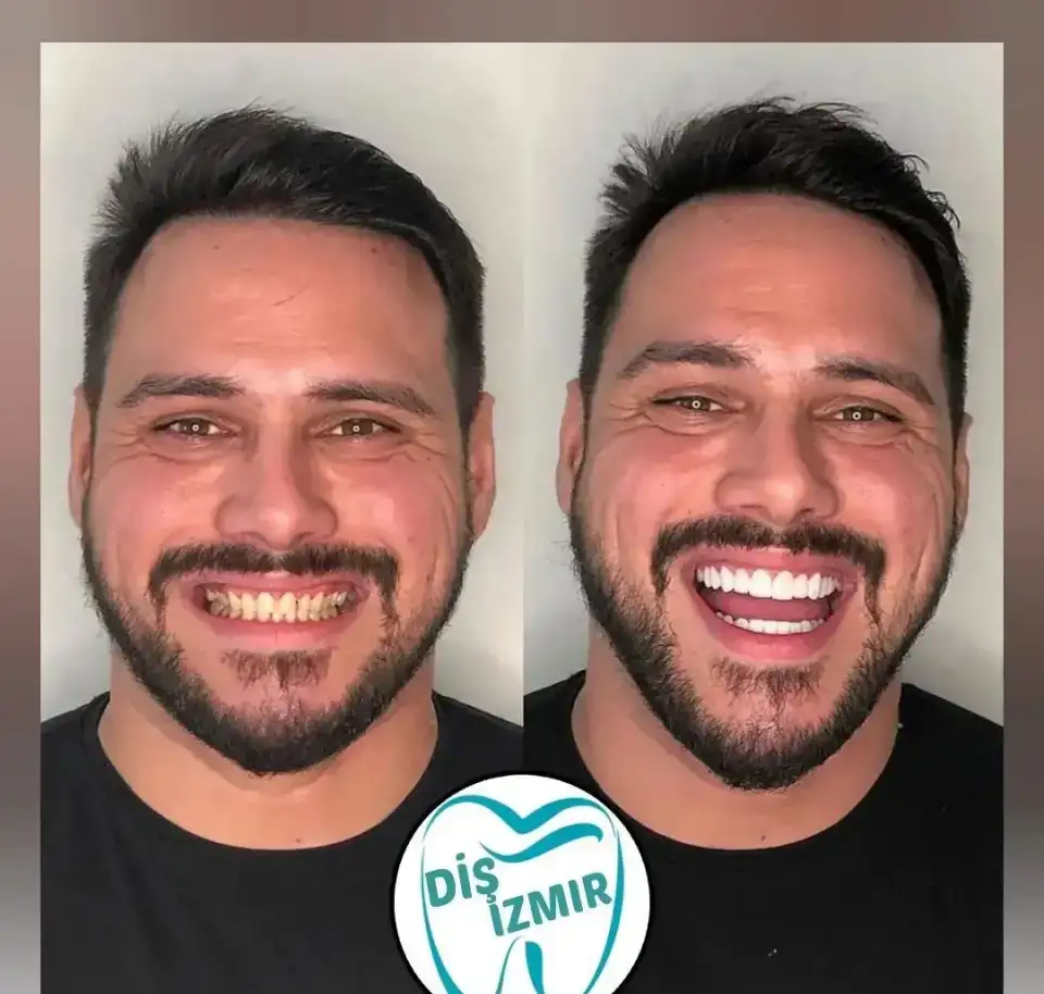 Go To Smile (СТОМАТОЛОГИЧЕСКИЙ ТУРИЗМ) (эстетическая стоматогия в Турции), фотография 8
