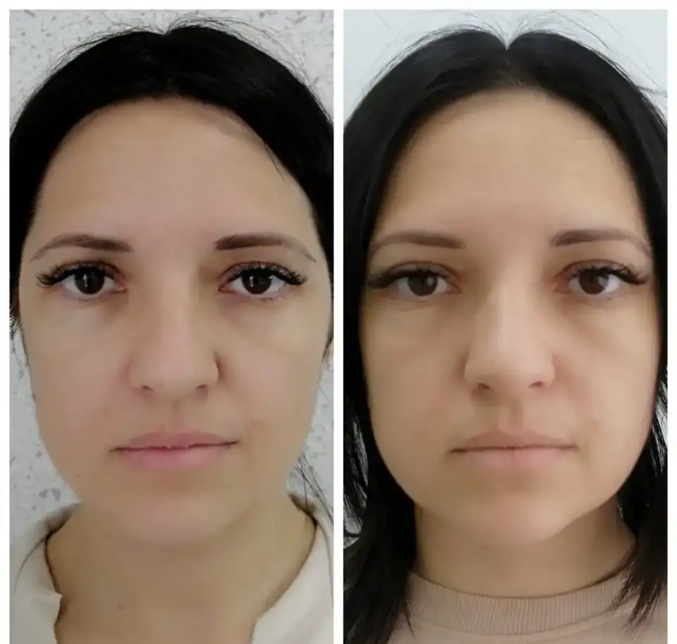 Естественное омоложение. Витапластика, фотография 7