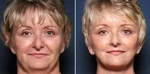 Нити Aptos. Лифтинг. ПОДТЯЖКА лица без операций., фотография 5